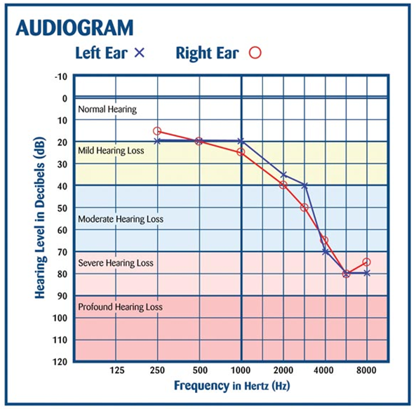 Example of an Audiogram graph - Hearing level in decibels on the left axis, with left ear and right ear readings marked on the graph - bottom axis showing 'Frequency in Hertz'