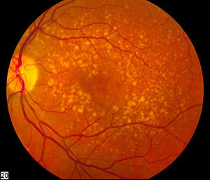 x-ray of eyeball showing signs of macular disease